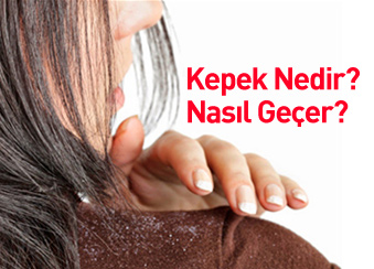 KEPEK NEDİR? NASIL GEÇER?