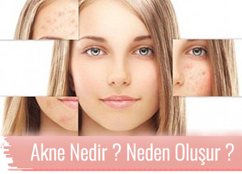 Akne nedir? Neden oluşur?