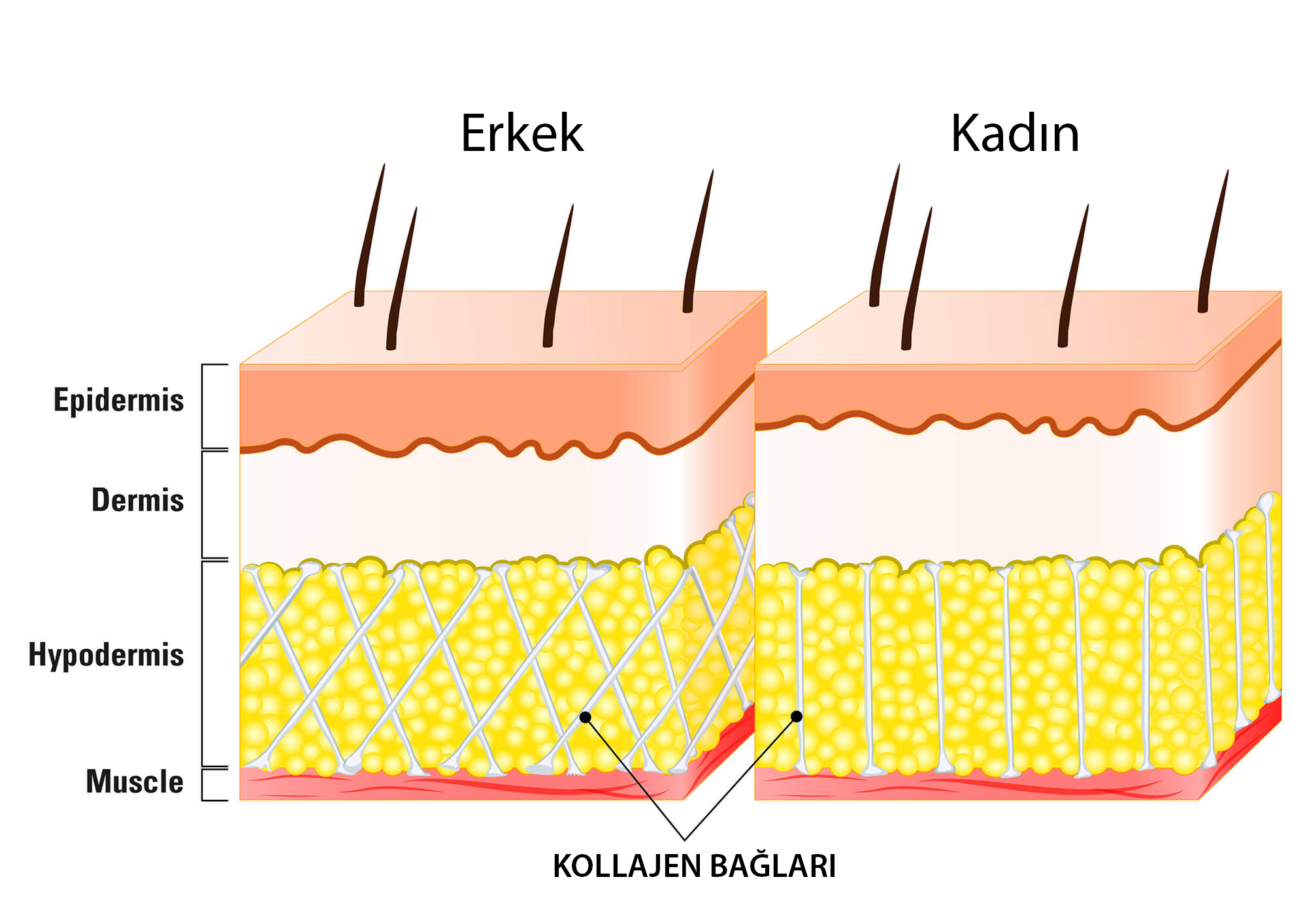 erkeklerde-selulit