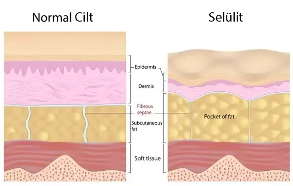 selulit-nedir